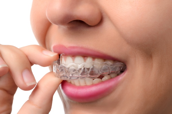 Can An Invisalign Dentist Fix My Gapped Teeth?