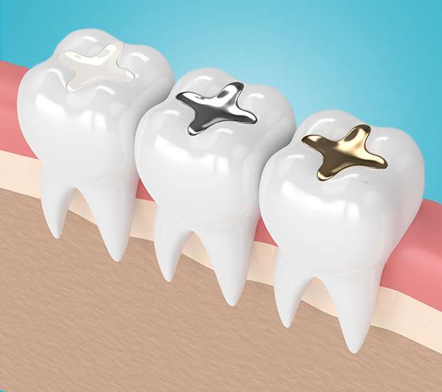 Reading Composite Fillings