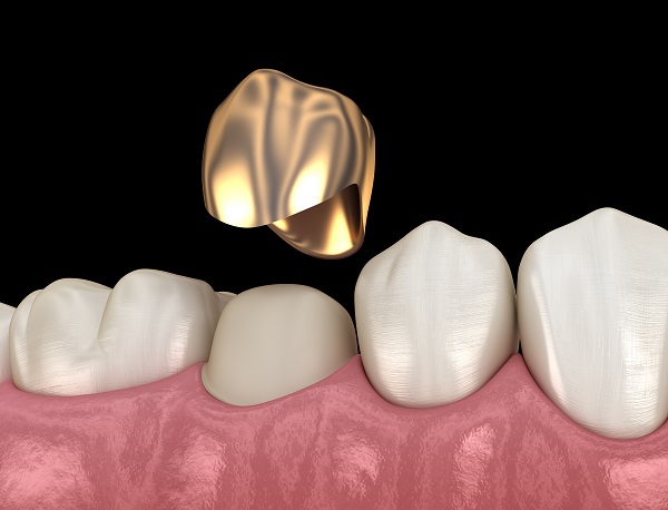 root canal metal crown