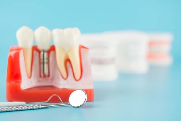 Life After Dental Implants