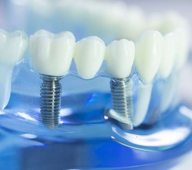 Reading Dental Implants